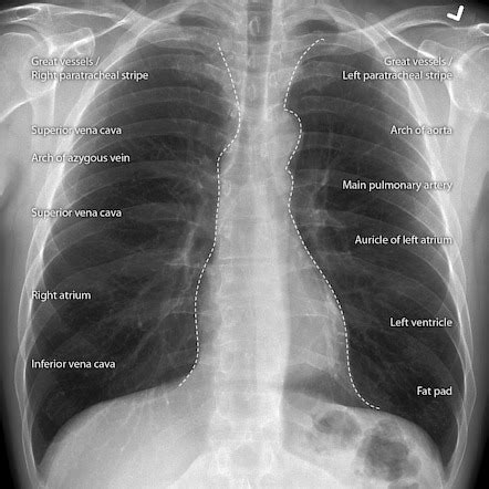 lv enlargement radiopaedia